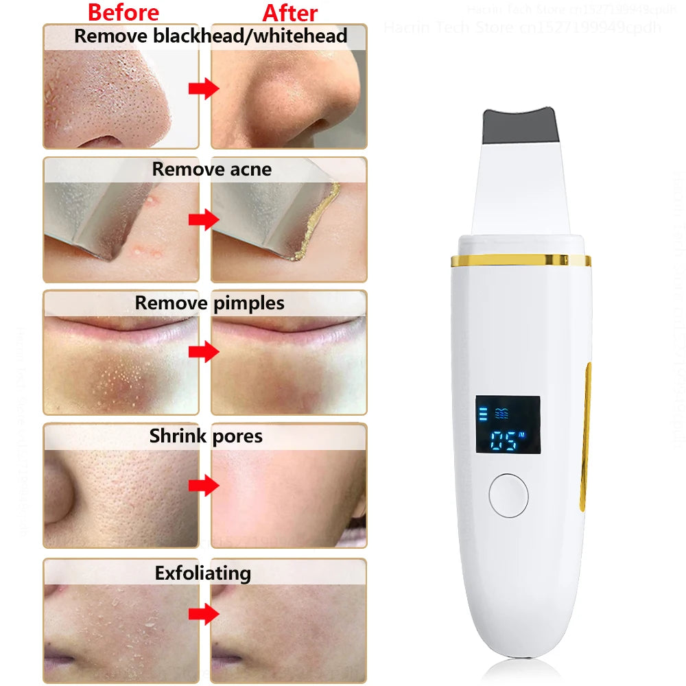 Ultrasonic Facial Scrubber Pro