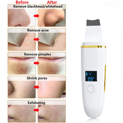 Ultrasonic Facial Scrubber Pro